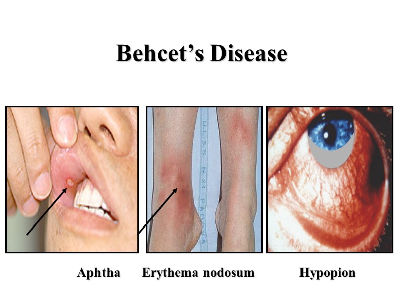 Behcet’s Disease Aphtha           